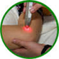 Akupunktur am Knie mit einem Laser 